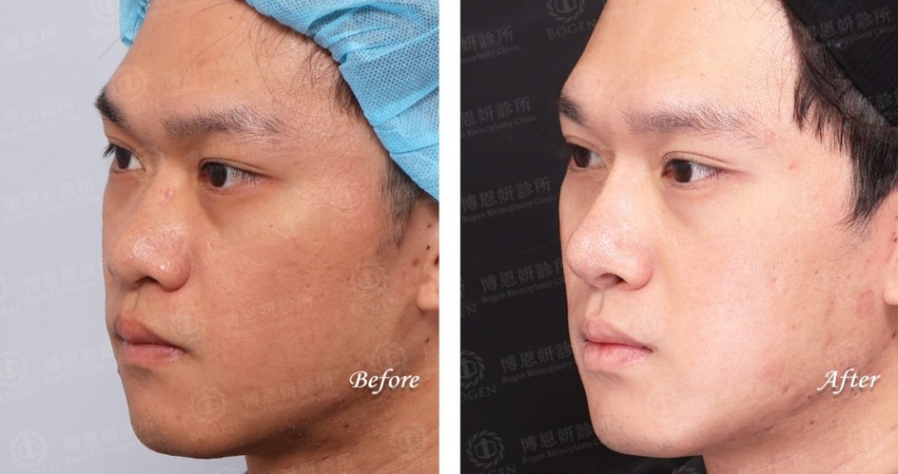 男性隆鼻,男性鼻整形,Fitme完形美,博恩妍