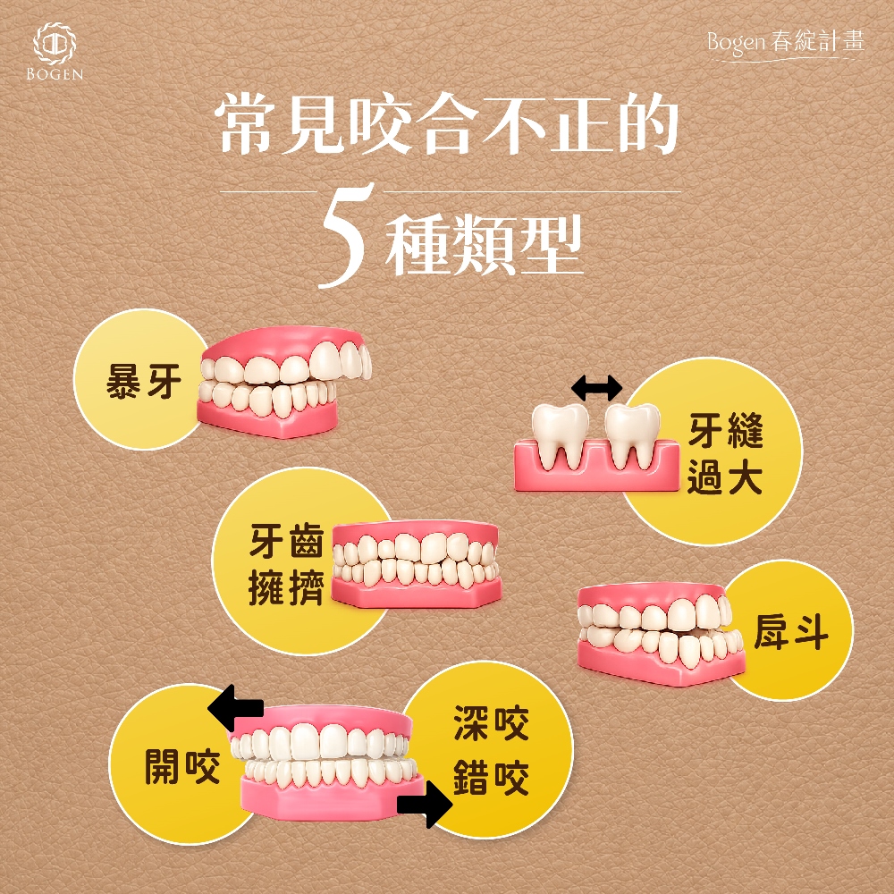 咬合不正有5種類型,咬合不正,博恩妍