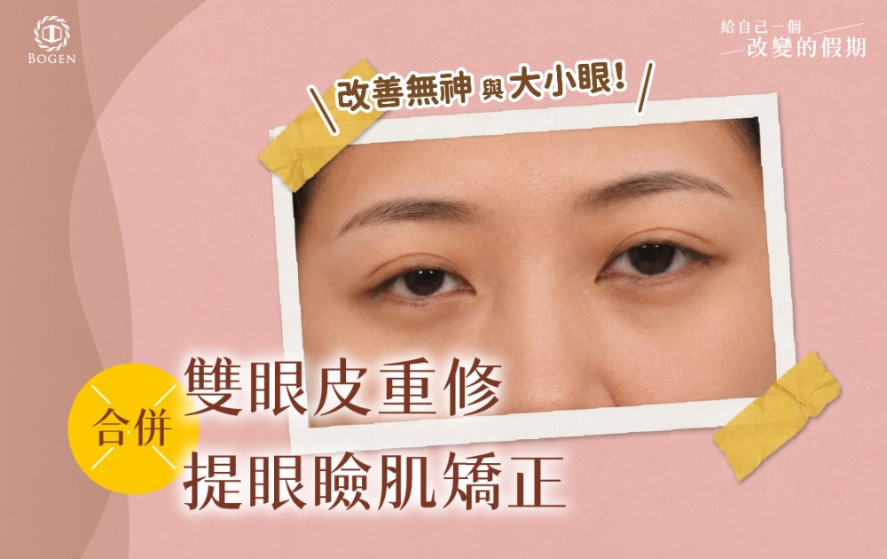 雙眼皮重修合併提眼瞼肌矯正,改善無神與大小眼!,博恩妍