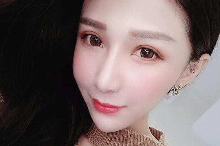 雙眼皮重修合併提眼瞼肌矯正手術,博恩妍
