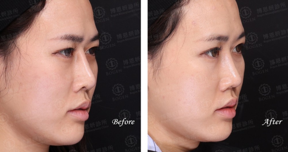 完形美鼻重修,FITME完形美,博恩妍