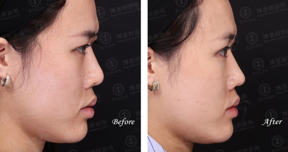 完形美鼻重修,FITME完形美,博恩妍