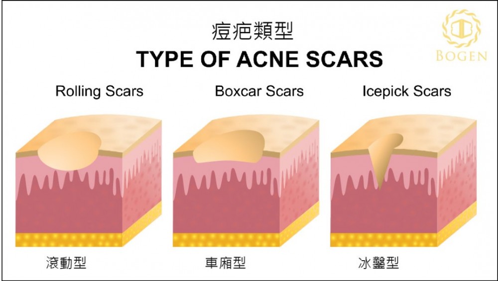 痘疤類型,痘疤分類,博恩妍