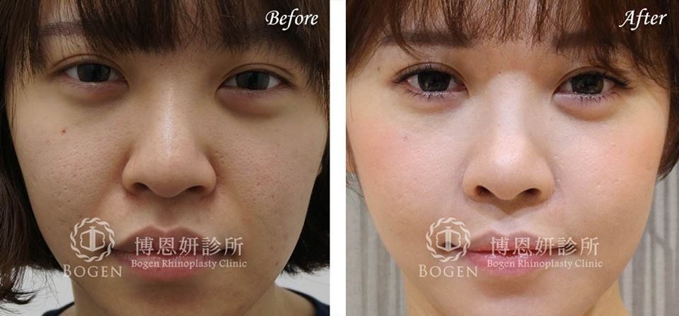 人工骨隆鼻取出,人工骨鼻衝修,博恩妍