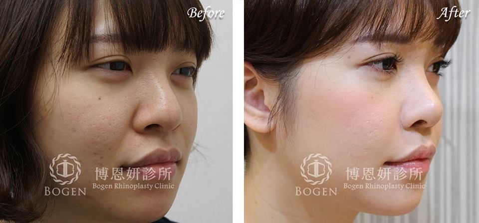 人工骨隆鼻取出,人工骨鼻衝修,博恩妍