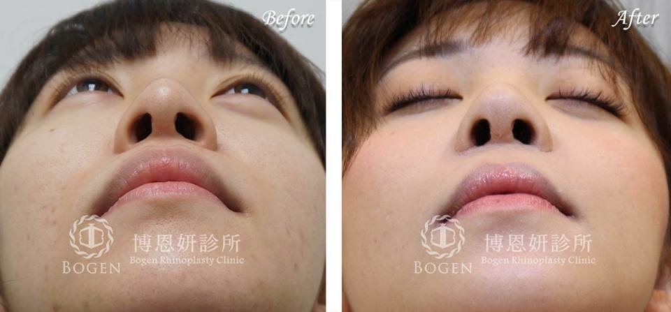 人工骨隆鼻取出,人工骨鼻衝修,博恩妍