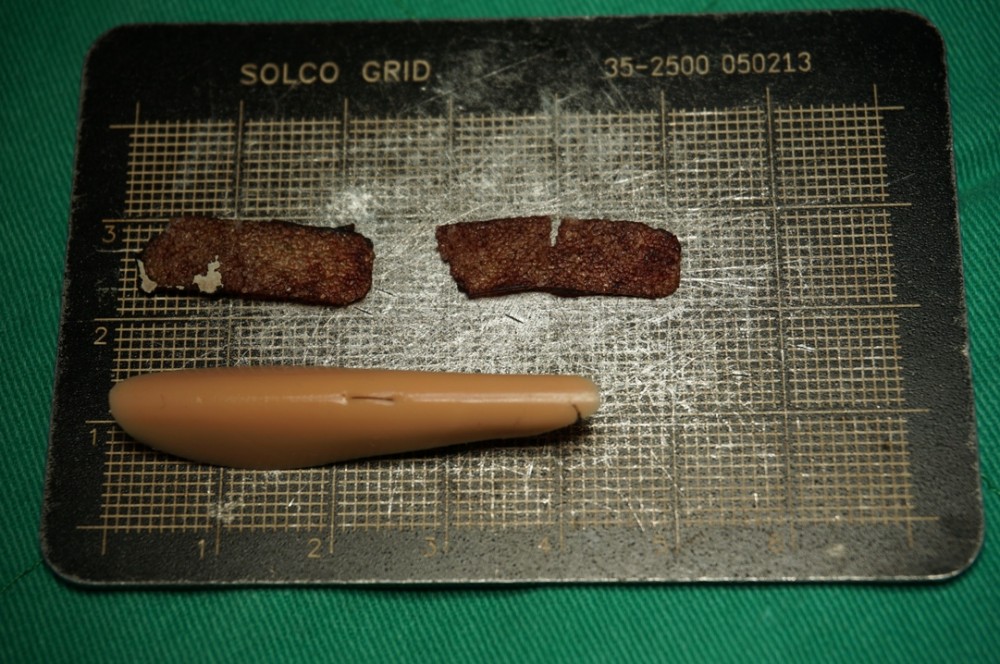 人工骨隆鼻取出,人工骨鼻衝修,博恩妍
