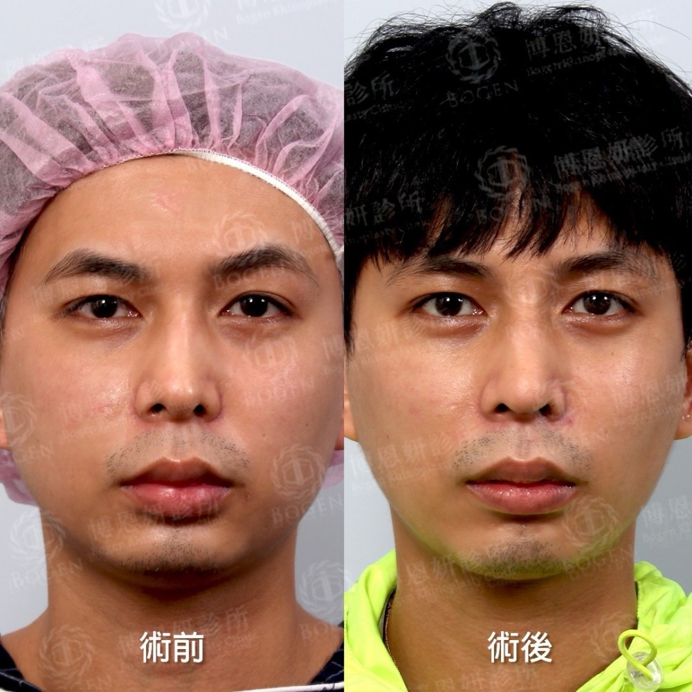 鼻重修推薦,鼻重修醫生,鼻中隔重建,博恩妍