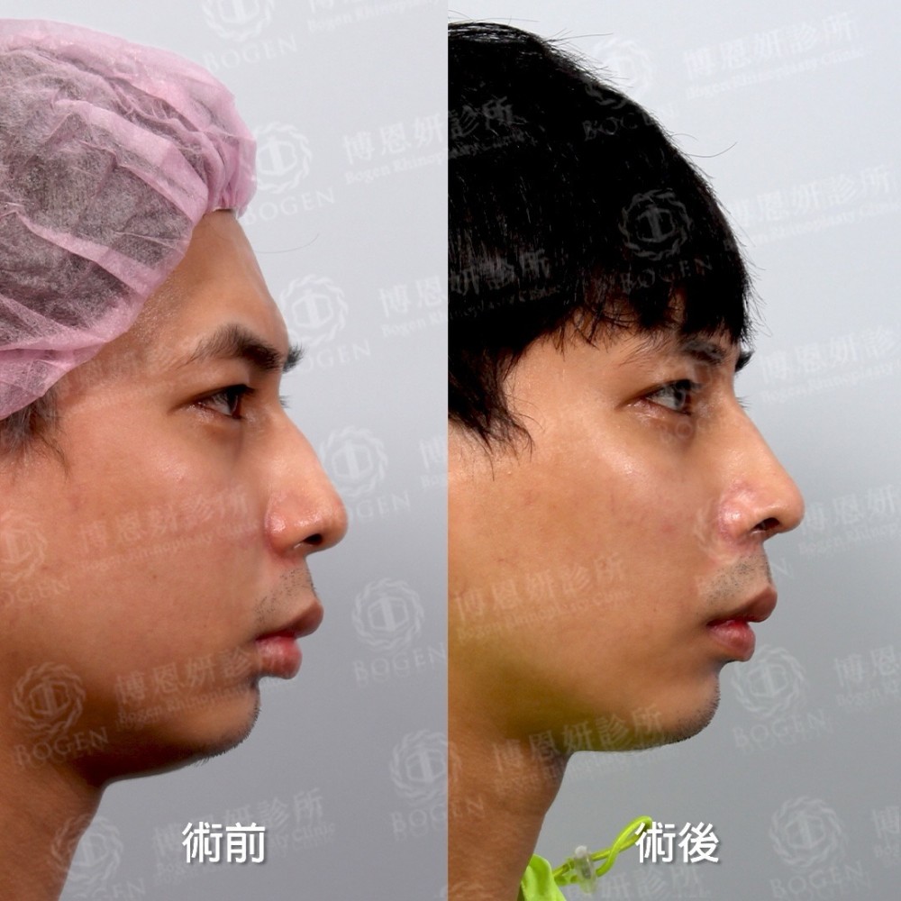 鼻重修推薦,鼻重修醫生,鼻中隔重建,博恩妍