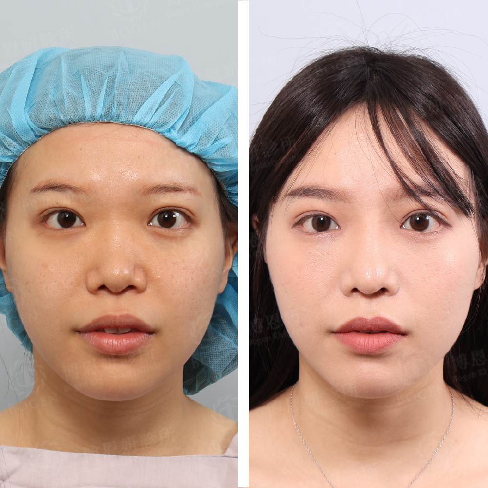 學生隆鼻,博恩妍,學生鼻整形