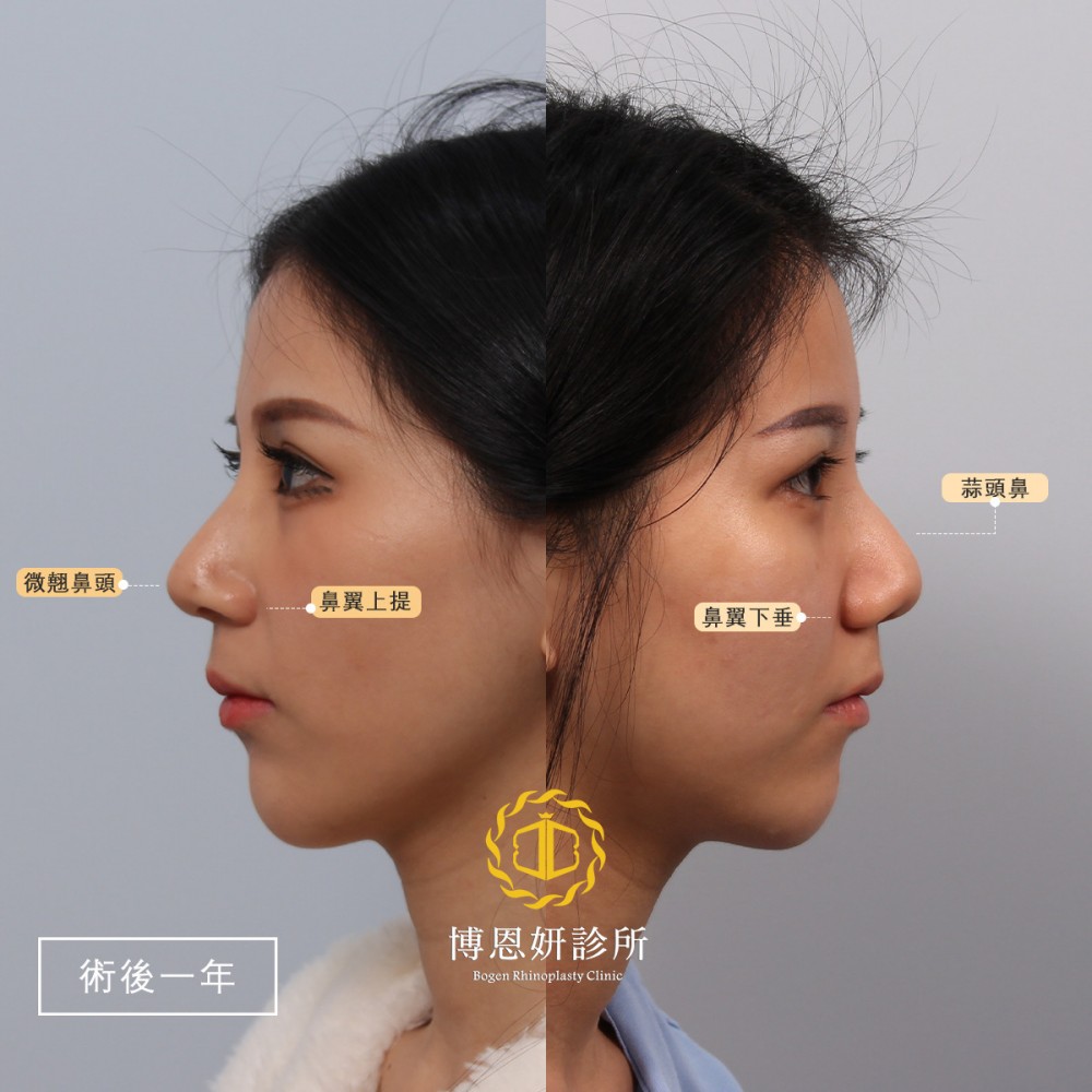 縮鼻頭與歪鼻矯正案例,縮鼻頭,歪鼻矯正,博恩妍