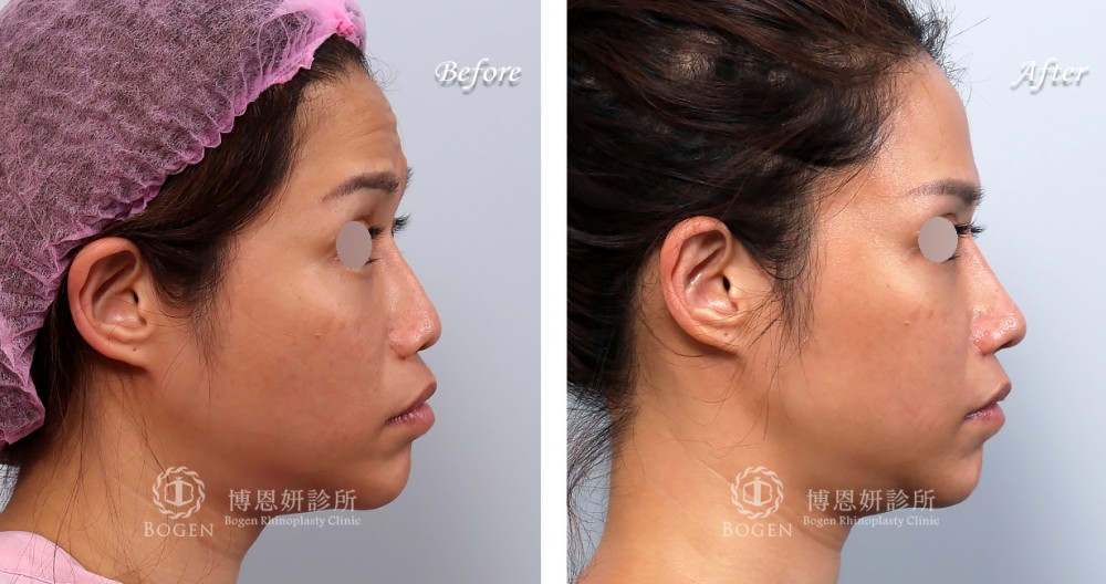 博恩妍診所張簡醫師鼻翼過度修除與鼻孔不對稱修復案例