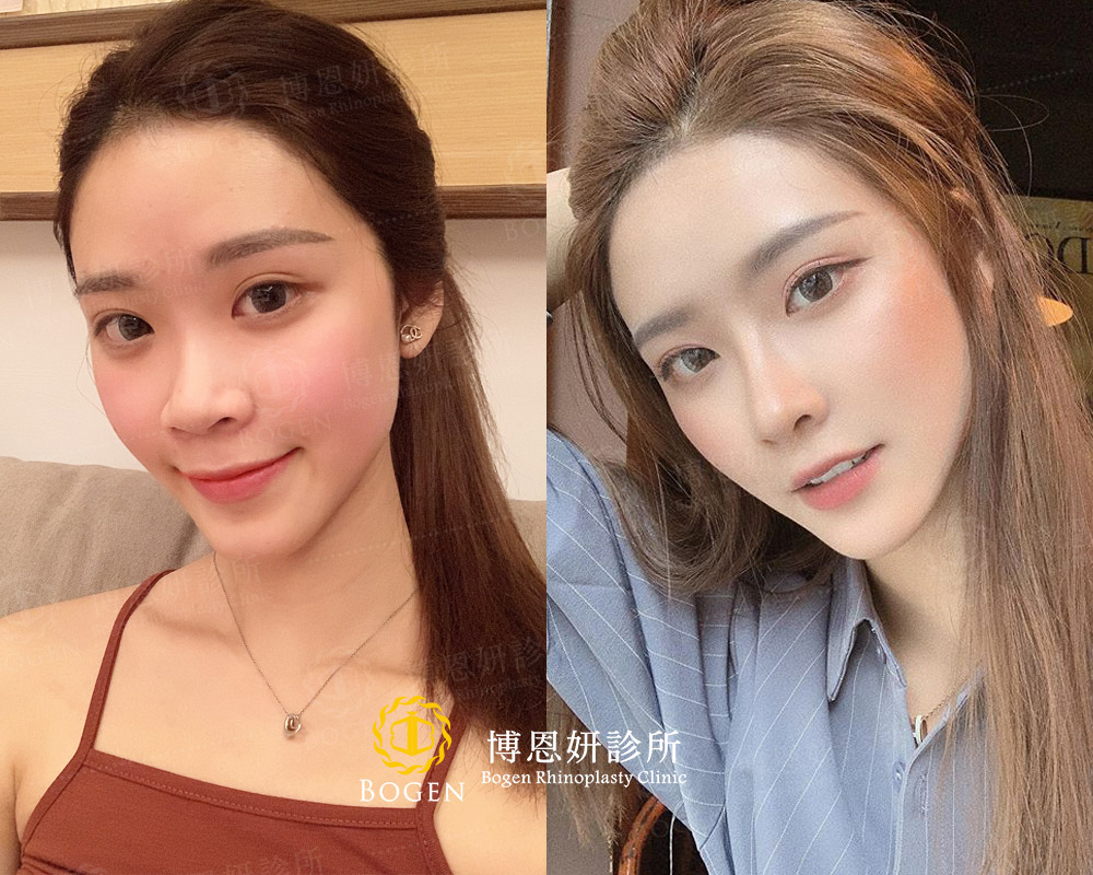 鼻翼手術注意重點有哪些？自然鵝蛋型鼻孔如何擁有？