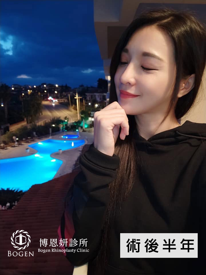 隆鼻假體邊緣感術後6個月案例,博恩妍