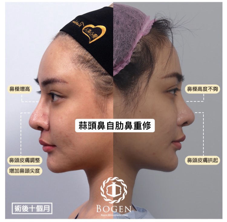 蒜頭鼻手術,蒜頭鼻自肋鼻重修,張簡仕煌醫師,博恩妍