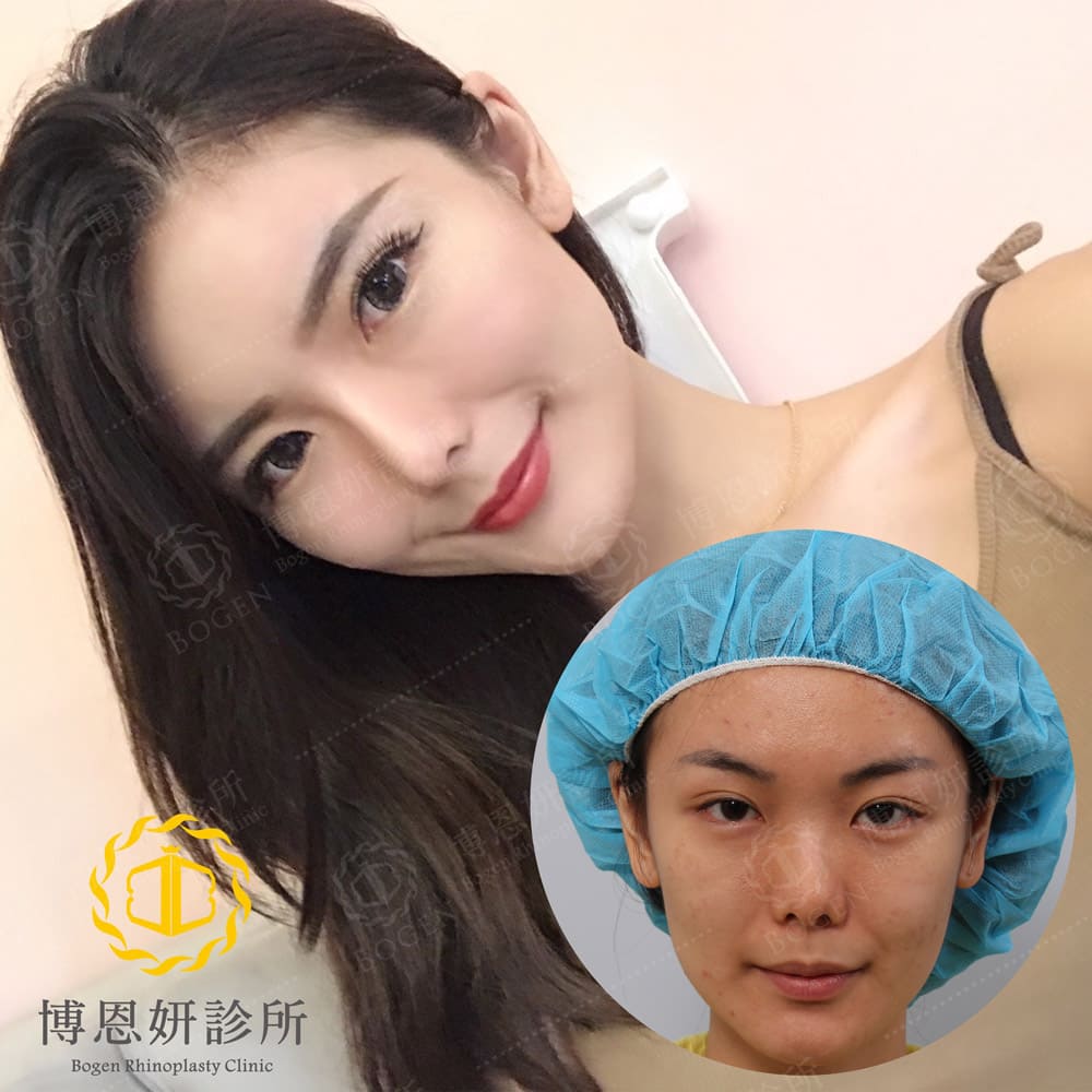 台北隆鼻手術,博恩妍診所李岳樺醫師臉部補脂手術案例