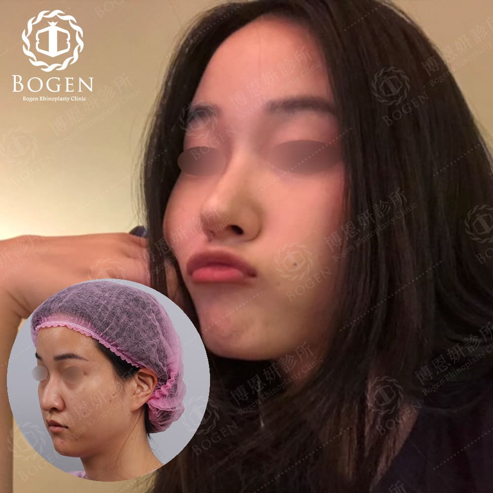 博恩妍診所張簡醫師改善巫婆鼻鼻整形手術案例