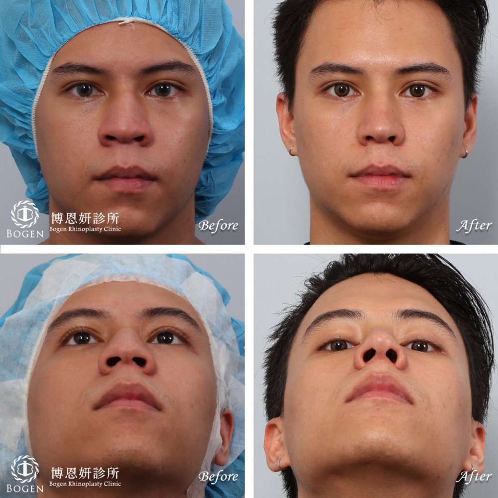 隆鼻手術,台北隆鼻手術推薦網路文章分享,隆鼻手術術後一年