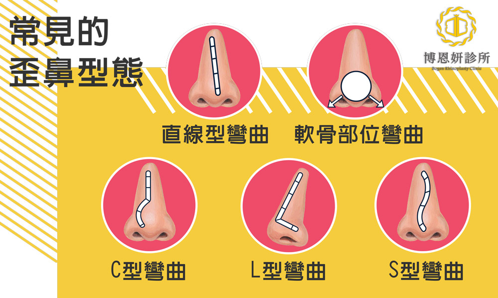 博恩妍診所張簡醫師講解歪鼻的型態與成因