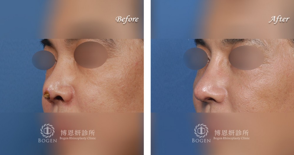 隆鼻假體鼻頭穿出重修鼻整形案例,張簡醫師,博恩妍診所