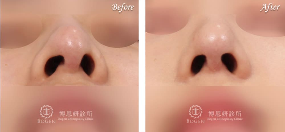 博恩妍診所鼻孔鼻小住不對稱合併鼻樑偏移案例