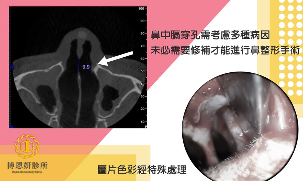 博恩妍診所張簡醫師詳述鼻黏膜破損解救方法