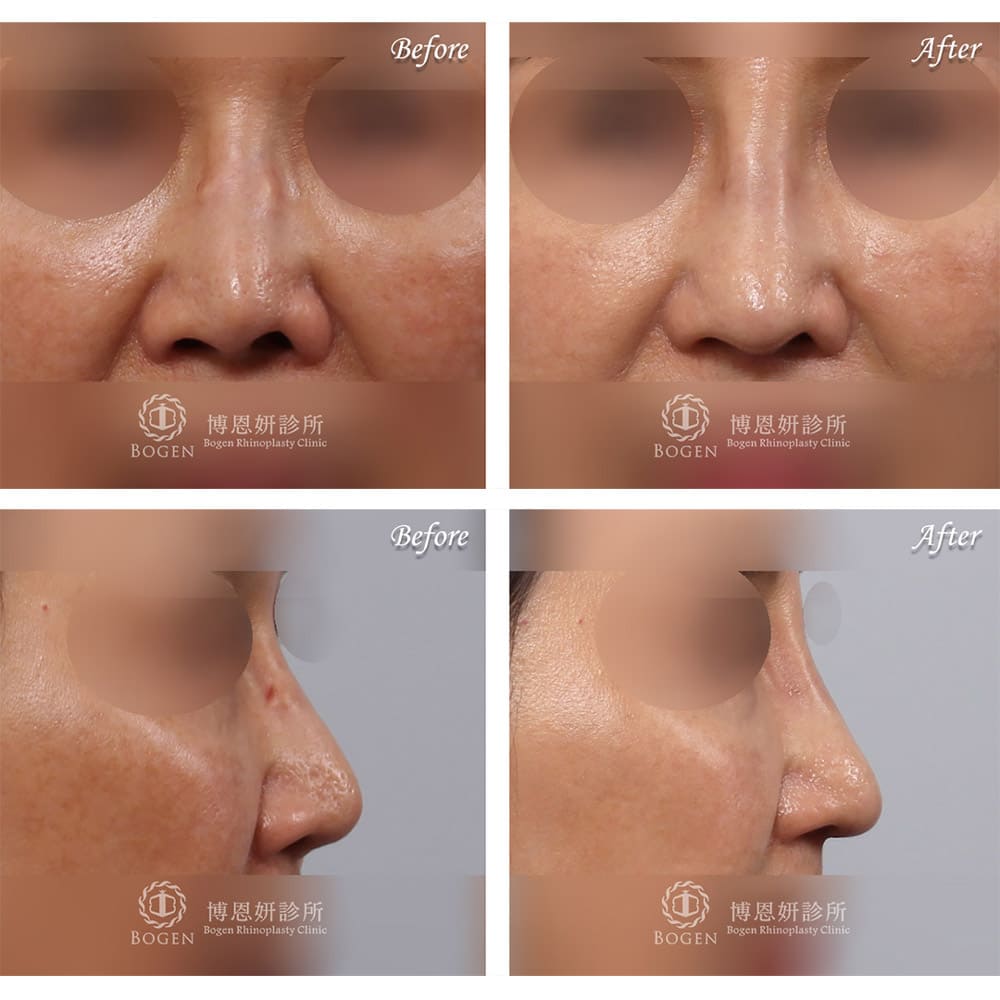 博恩妍診所張簡醫師不對稱性攣縮鼻鼻重修鼻頭延長
