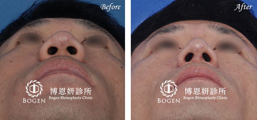 鼻翼下垂案例改善鼻整形手術,博恩妍診所