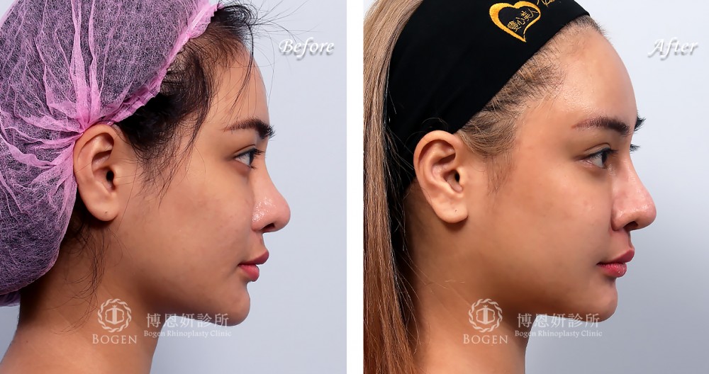 博恩妍診所張簡醫師蒜頭鼻鼻整形重修半肋手術案例