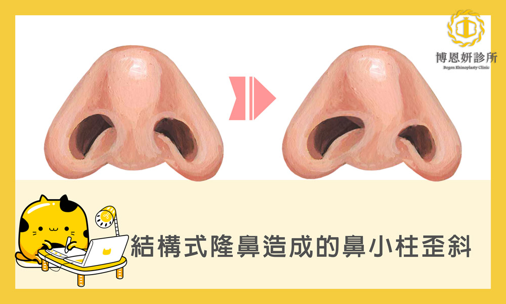 博恩妍診所張簡醫師簡述結構是隆鼻造成的鼻小住歪斜鼻孔不對稱