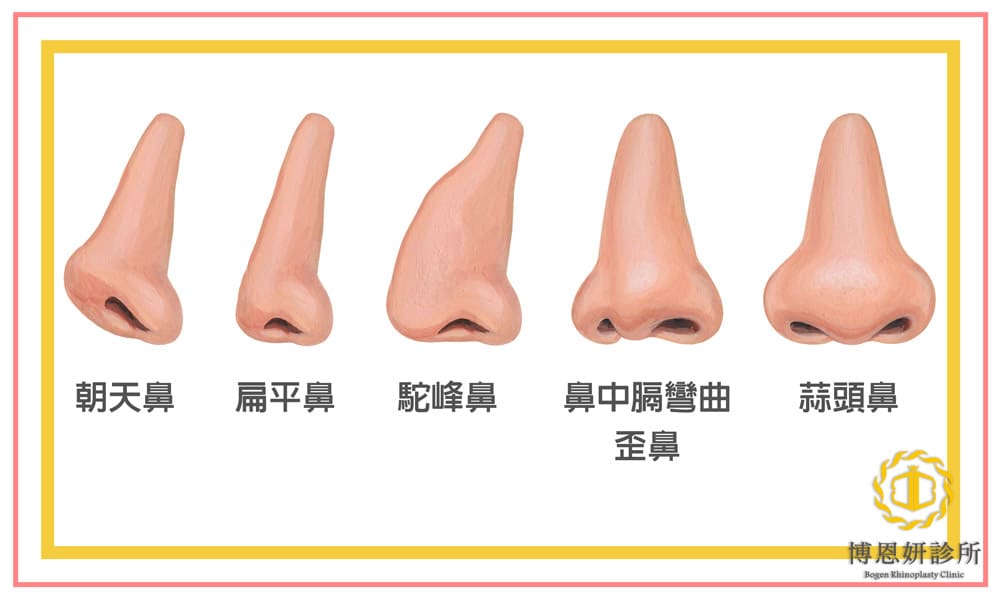 各式鼻型詳細圖示,博恩妍診所