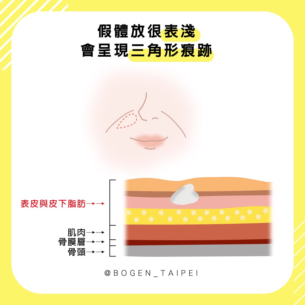 法令紋手術墊片過淺觸感略硬,法令紋手術,博恩妍