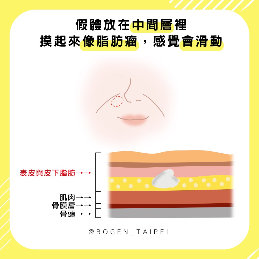 法令紋手術墊片置放中層像滑動脂肪瘤,法令紋手術,博恩妍