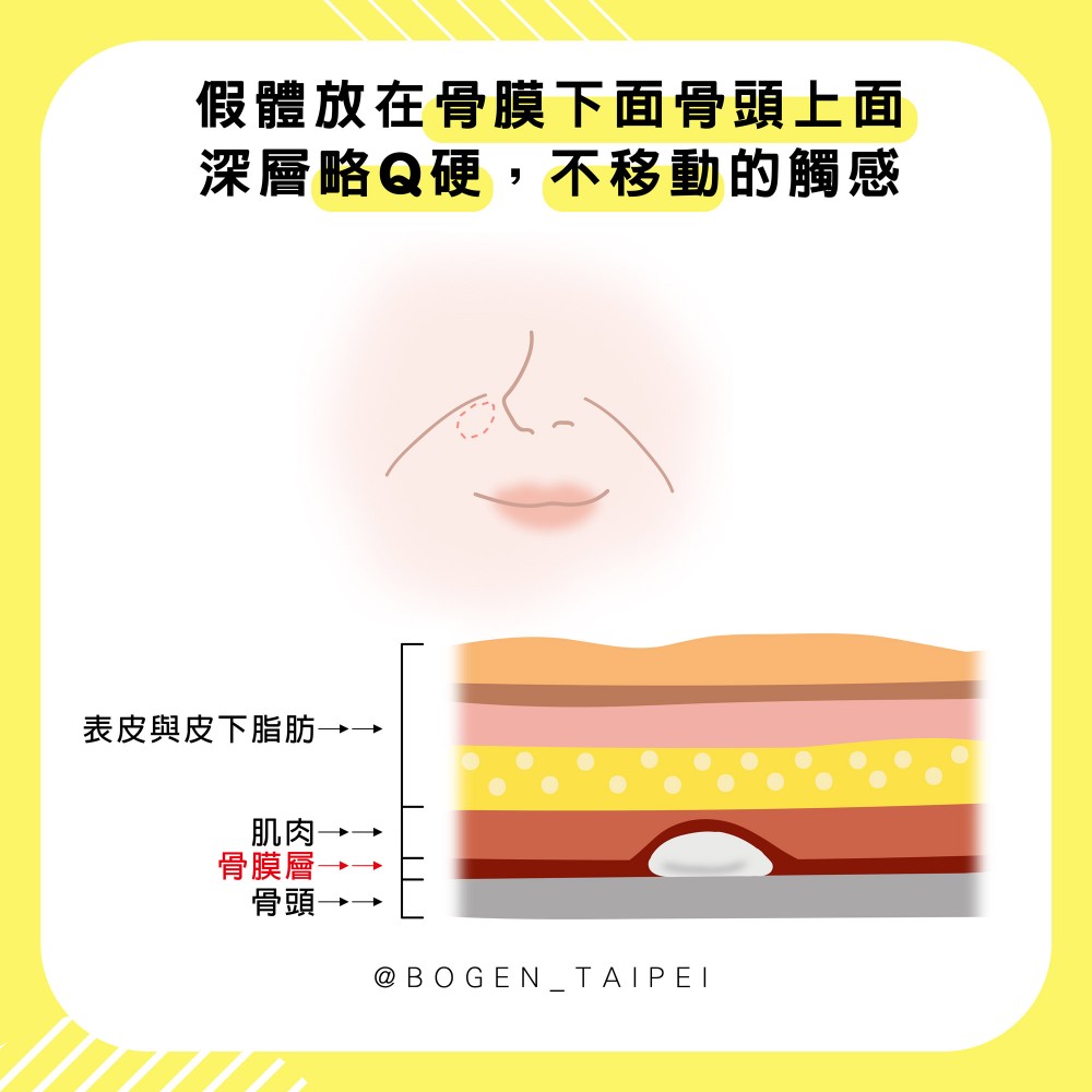 法令紋手術墊片置放骨膜下方,法令紋手術,博恩妍