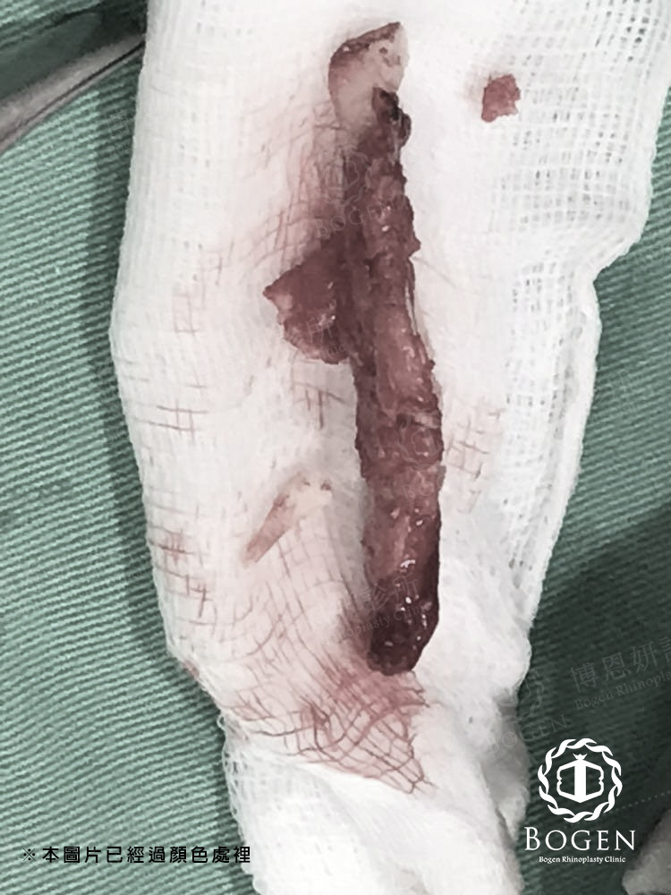 矽膠隆鼻鈣化取出,博恩妍