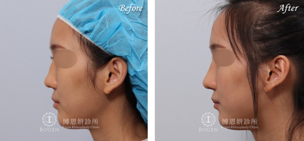 博恩妍診所張簡醫師自體肋軟骨延長鼻頭與重建鼻中膈費用