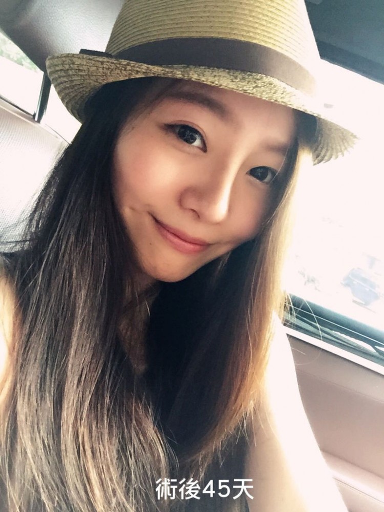 韓系娃娃鼻案例,韓系娃娃鼻,娃娃鼻,隆鼻,博恩妍