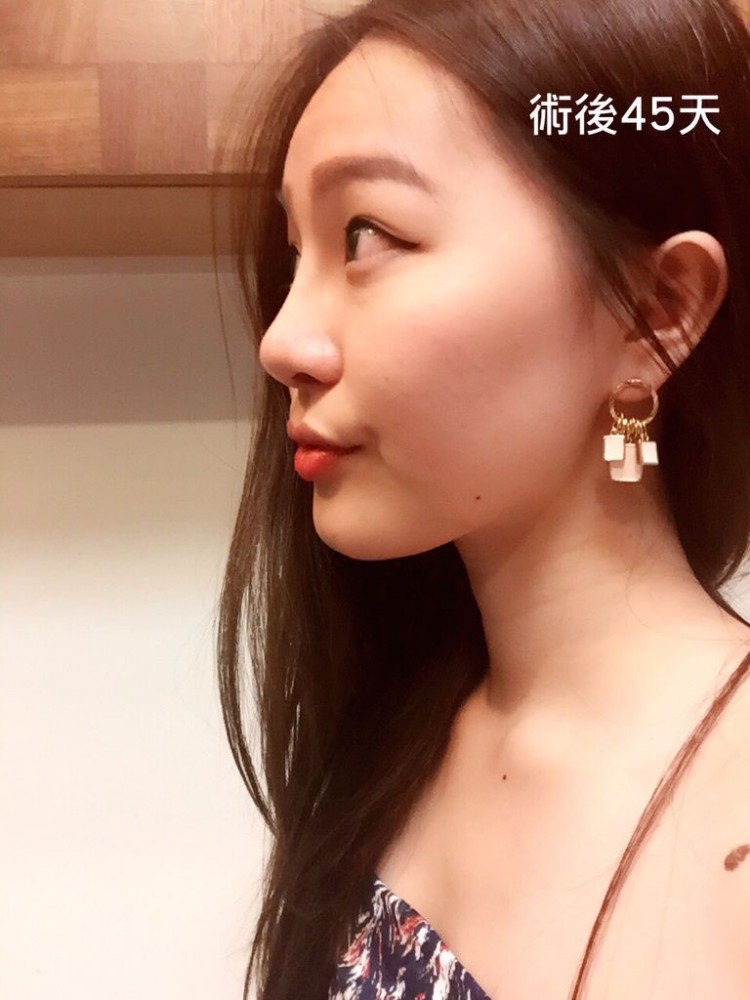韓系娃娃鼻案例,韓系娃娃鼻,娃娃鼻,隆鼻,博恩妍