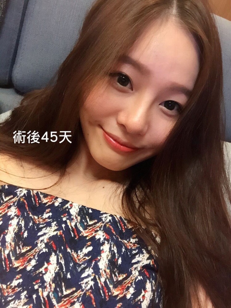 韓系娃娃鼻案例,韓系娃娃鼻,娃娃鼻,隆鼻,博恩妍