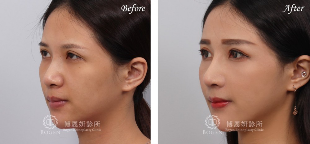 女性隆鼻,博恩妍