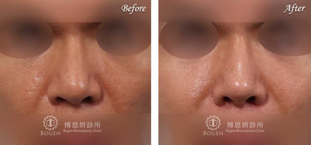 縮鼻翼推薦博恩妍診所張簡醫師縮鼻翼權威
