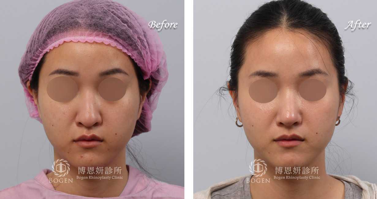 鼻整形術前術後照鼻整形案例15,鼻整形手術推薦博恩妍診所張簡醫師
