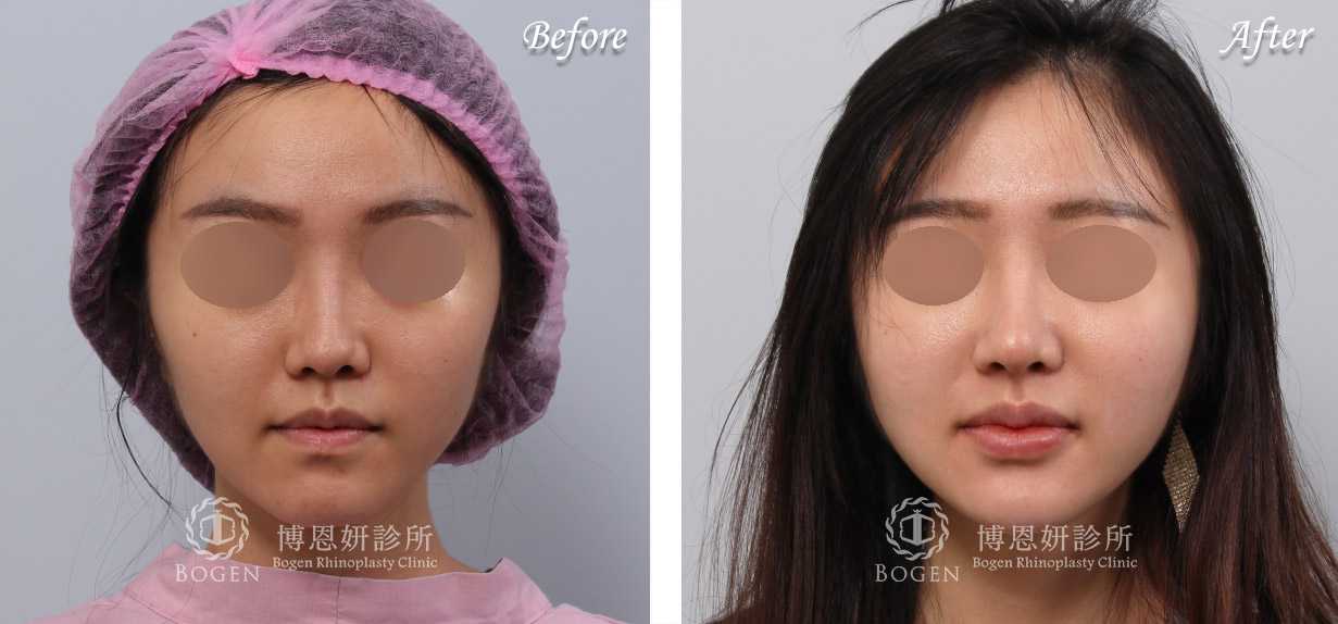 鼻整形術前術後照鼻整形案例21,鼻整形手術推薦博恩妍診所張簡醫師