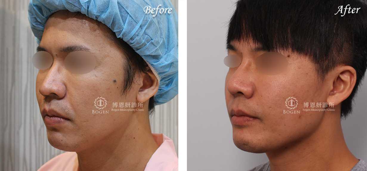 縮鼻翼推薦博恩妍診所張簡醫師縮鼻翼權威