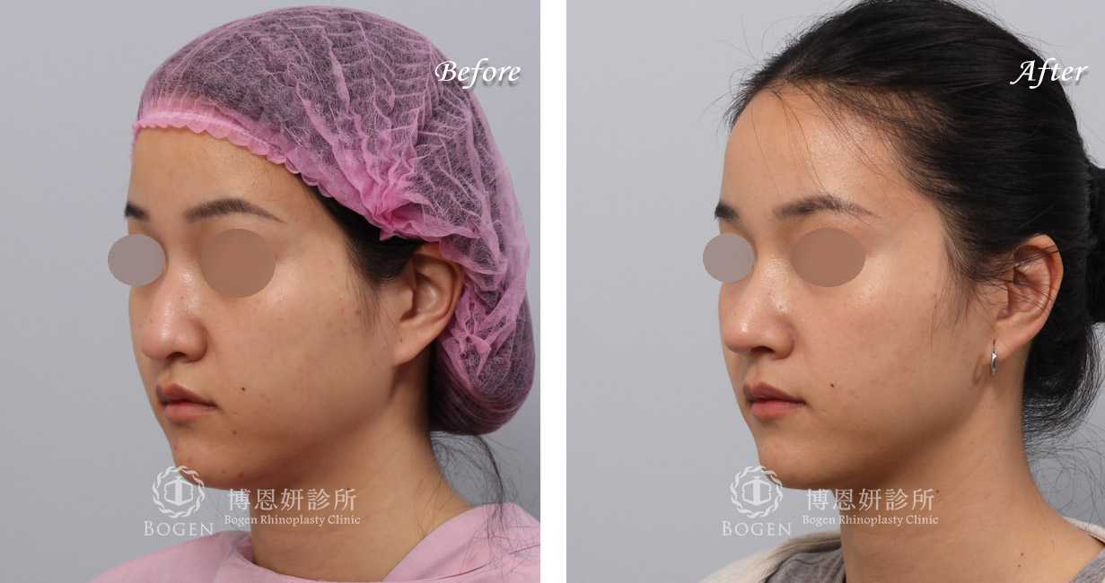 鼻整形術前術後照鼻整形案例15,鼻整形手術推薦博恩妍診所張簡醫師