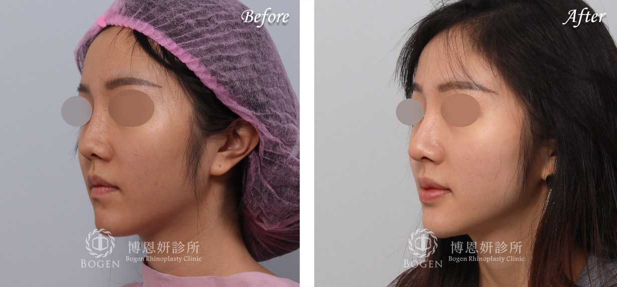鼻整形術前術後照鼻整形案例21,鼻整形手術推薦博恩妍診所張簡醫師