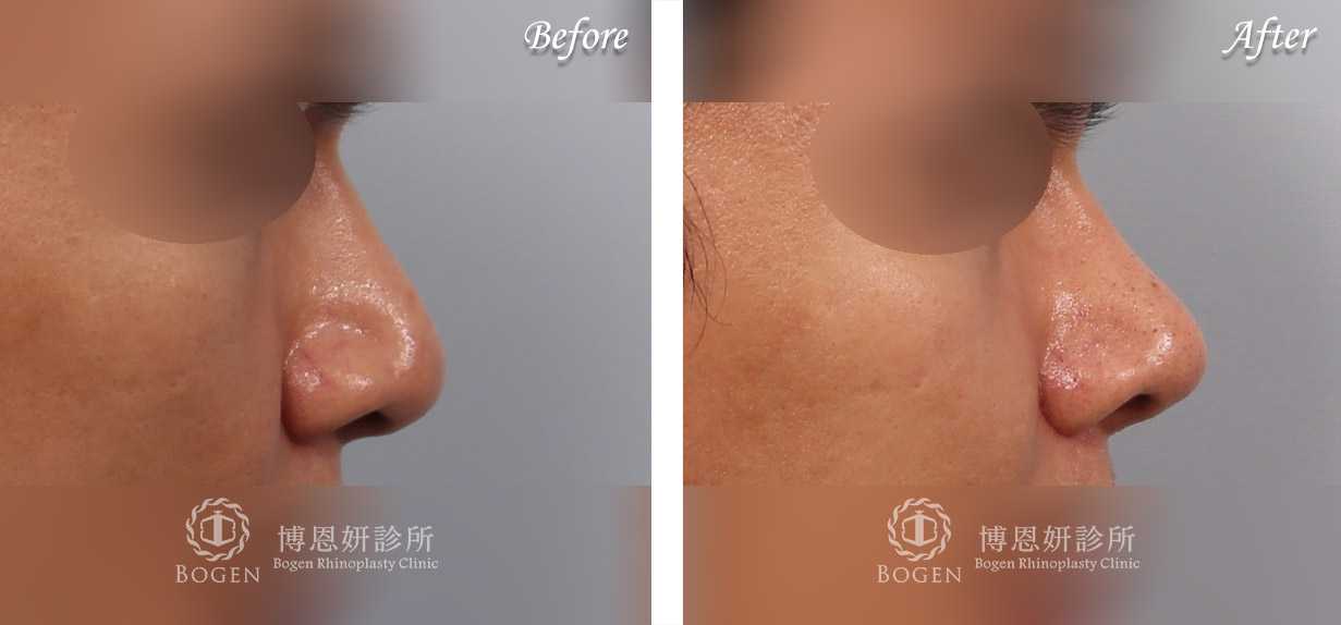 縮鼻翼推薦博恩妍診所張簡醫師縮鼻翼權威
