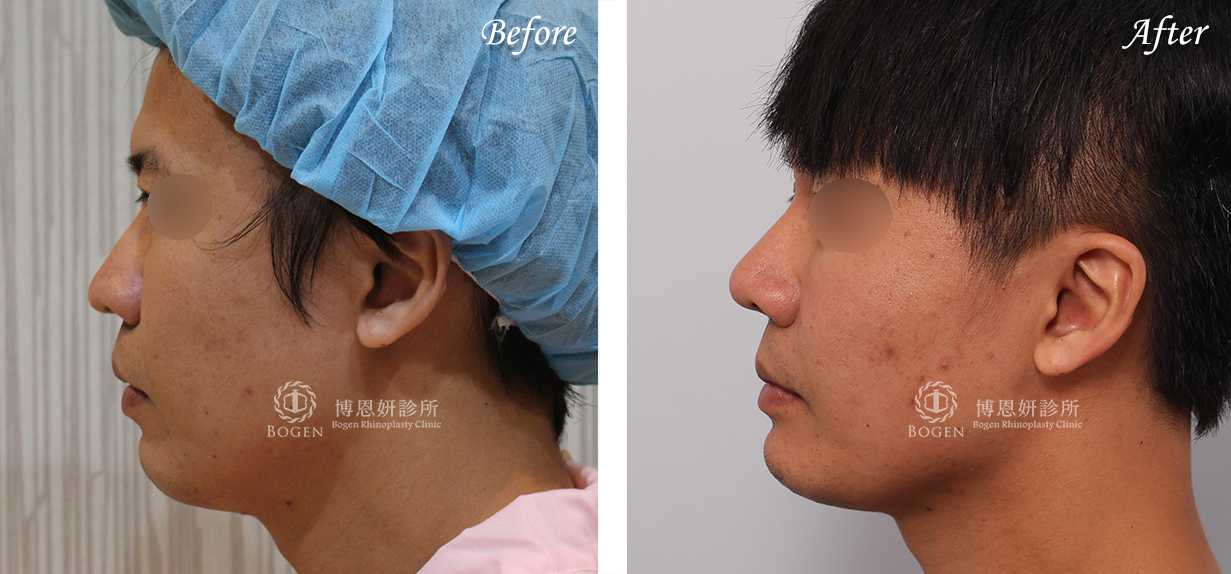 縮鼻翼推薦博恩妍診所張簡醫師縮鼻翼權威