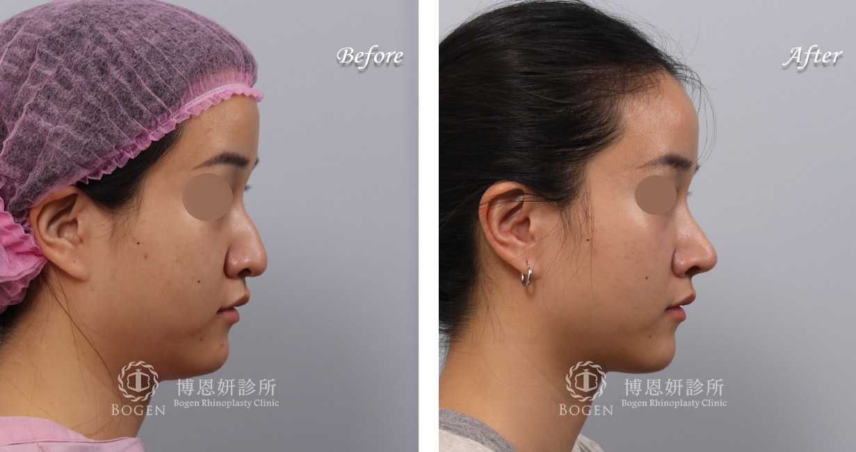 鼻整形術前術後照鼻整形案例15,鼻整形手術推薦博恩妍診所張簡醫師