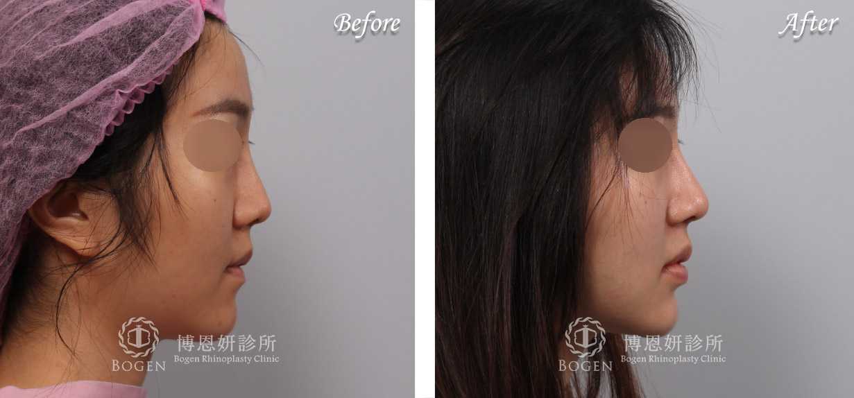 鼻整形術前術後照鼻整形案例21,鼻整形手術推薦博恩妍診所張簡醫師